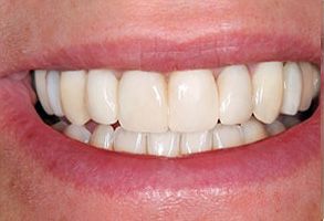 MD Family Dental Care | Periodontal Treatment, Digital Impressions and Veneers
